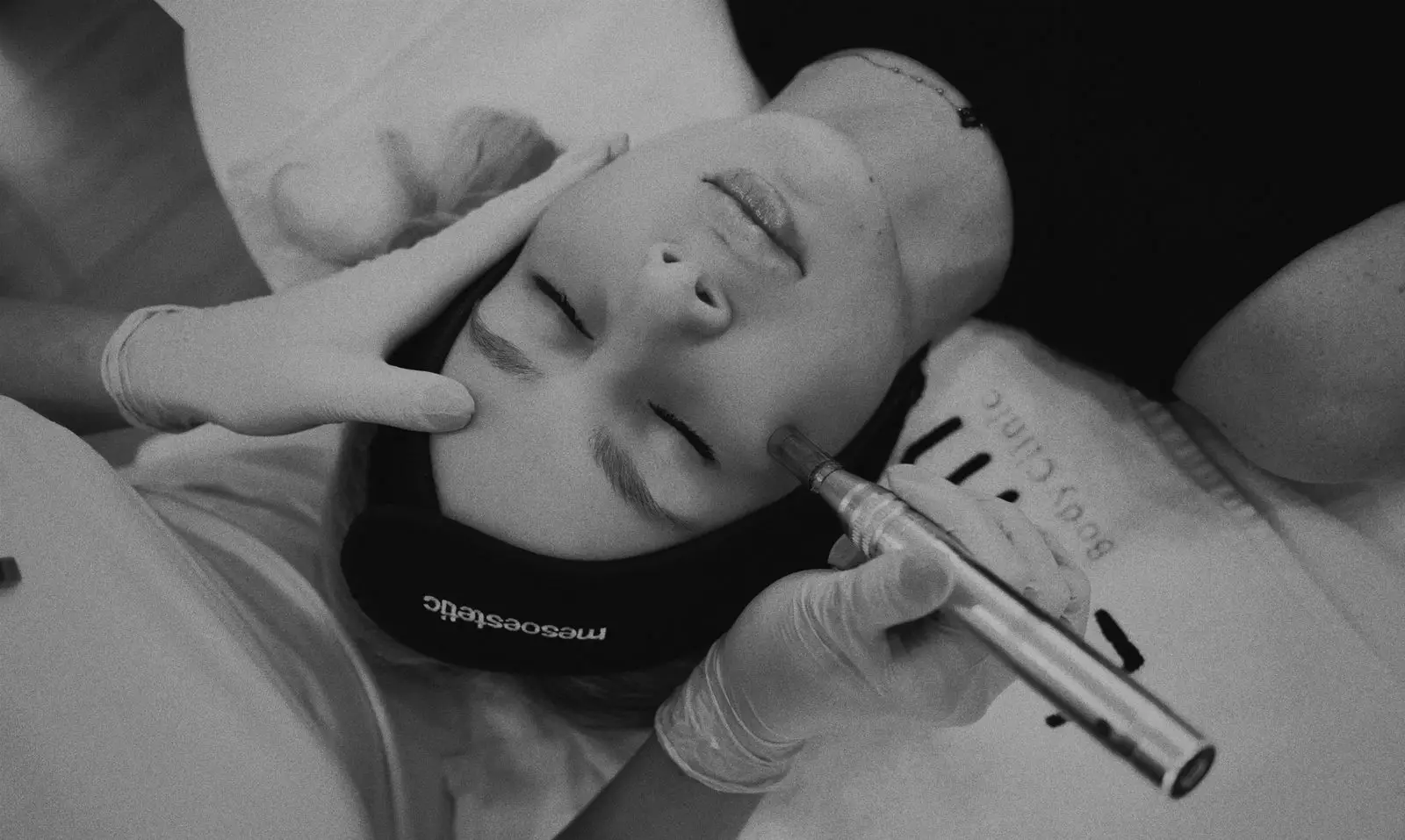 Microneedling tretman lica u Luma Body Clinic, Zagreb